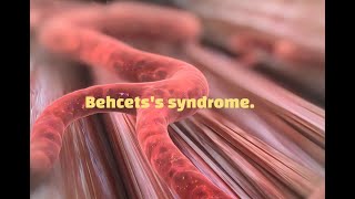 Behcet syndrome [upl. by Emmeram]