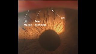 Laser Peripheral Iridotomy Tips and Tricks Malik Y Kahook MD [upl. by Ejroj231]