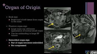 03 Approach to Peritoneal and Retroperitoneal Masses [upl. by Einnad]