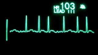 Atrial Fibrillation [upl. by Hoeg]