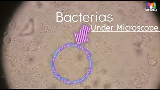 Bacteria seen under MicroscopeBacteria in urineNitrite PositiveSevere UTI Urine tract infection [upl. by Larimor]