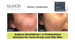 blemiderm® free the skin from blemishes [upl. by Anne]