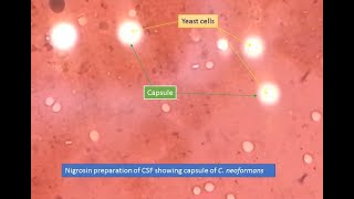 Cryptococcus capsules in Nigrosin preparation [upl. by Michigan]