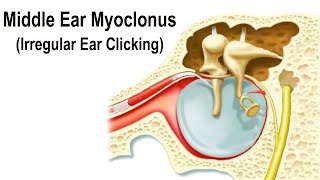 Middle Ear Myoclonus  Irregular Clicking Sound in the Ear [upl. by Oflodor279]