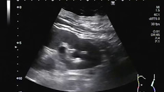 Ultrasound Video showing a stone and sand particlessludge in the ureter [upl. by Ahsinrad]