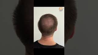 Transplantacija kose hairtransplantation haartransplantatieistanbul [upl. by Ahtamat]