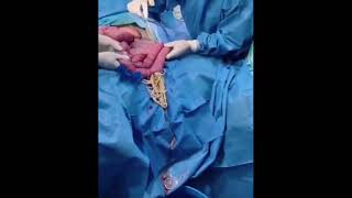 Trigger Warning Ascaris Lubricoides Intestinal Worms Parasite Removal Surgery [upl. by Catina]