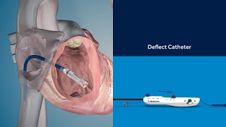 Micra TPS Implant Procedure Animation [upl. by Celesta]