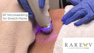 RF microneedling for stretch marks [upl. by Tessil]