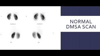 Static Renal Scintigraphy MCQ DMSA RenalScintigraphy renalscan scfhs nuclearmedicineMCQ [upl. by Assenev]