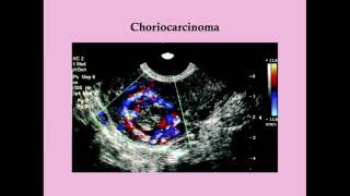 What is Gestational Trophoblastic Disease [upl. by Aredna972]