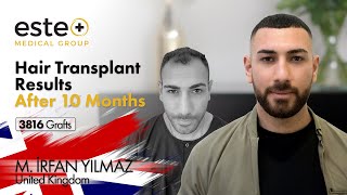 Hair Transplant Result After 10 Months 3816 Grafts hairtransplantbeforeafter hairtransplantresults [upl. by Miltie906]