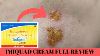 quotImiquad Cream Review Skin Wars and Wart Whispers 💪🌟 SkinSuperhero ImiquadUnveiledquot [upl. by Gard735]