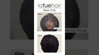 Stem Cell Therapy for Hair [upl. by Aholla]