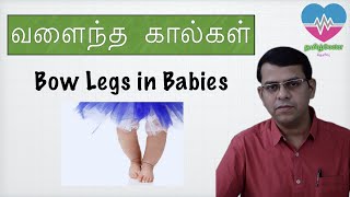 வளைந்த கால்கள்  Bow legs in babies  தமிழ் [upl. by Netneuq601]