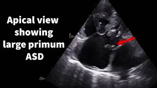 Transitional atrioventricular septal defect [upl. by Norvall168]