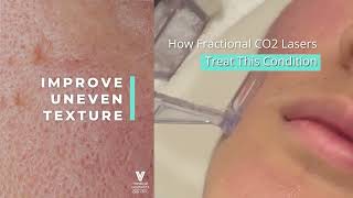 Fractional CO2 Laser Singapore  FAQ  Acne Scars Treatment [upl. by Biddie]