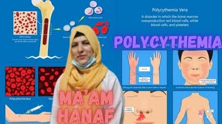 quotUnderstanding Polycythemia Causes Symptoms and Treatment Optionsquot [upl. by Adniralc945]