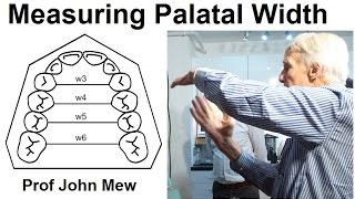 Measuring the Width of the Upper Jaw Palate Maxilla in Orthodontic Treatment by Prof John Mew [upl. by Donela414]