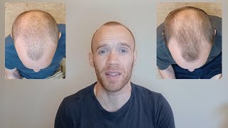 Rosemary Oil for Hair Growth  6 Month Results [upl. by Merilyn]