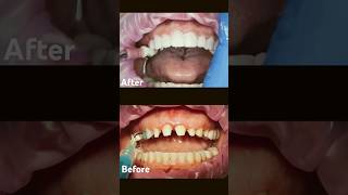 Restoration of upper Teeth  whitening of Teeth shorts dentist youtubeshorts [upl. by Rabma553]