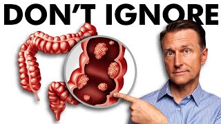 The Early Signs of Colon Cancer You DONT Want to Ignore [upl. by Kuebbing]