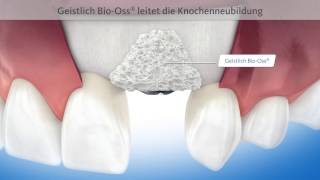 3DAnimation Zahnmedizin Alveolarwanddefekt Knochenaufbau Oberkiefer GEISTLICH [upl. by Parcel923]