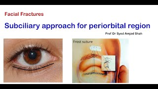 Subciliary approach for Periorbital region  English  Oral Maxillofacial Surgery  Syed Amjad Shah [upl. by Ayhtin]