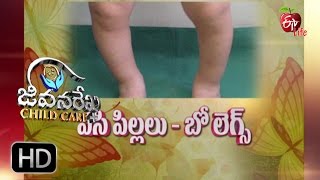 Jeevanarekha child care  Bow Legs  9th November 2016  జీవనరేఖ చైల్డ్ [upl. by Edric]