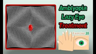 Amblyopia Lazy Eye Treatment Exercise 35  تمارين علاج كسل العين غمش العين الكسولة رقم 35 [upl. by Noir]