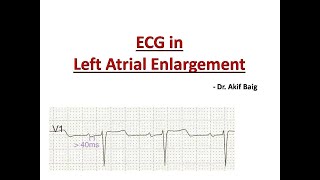 ECG in Left Atrial Enlargement  Dr Akif Baig [upl. by Ulphia]