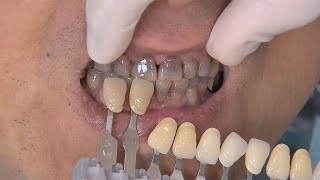 Chairside Live Episode 41 Using BruxZir® Solid Zirconia on TetracyclineStained Teeth [upl. by Vale]