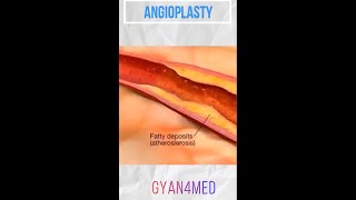 Coronary angioplasty Femoral Access [upl. by Carly]