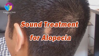 Alopecia Areata Treatment  Regrowth Hair丨Healing Frequency丨Repair Hair Follicles [upl. by Roter585]