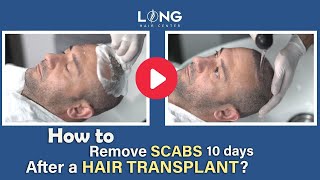 How to remove scabs 10 days after a hair transplant ll Long Hair Center [upl. by Ahtnammas]