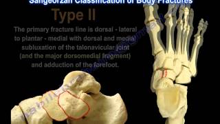 Navicular Fractures  Everything You Need To Know  Dr Nabil Ebraheim [upl. by Disraeli]