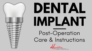 What To Do After Getting a Dental Implant  experienceHFD [upl. by Medina]