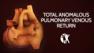 Total Anomalous Pulmonary Venous Return [upl. by Denni]