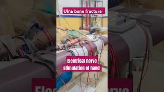 ulna bone fracture treatment elbowpain electrical nerve stimulation tens machine shorts physio [upl. by Ellehcrad]