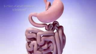 MGB Mini Gastric Bypass surgical procedure Animated version [upl. by Ynohtnad]