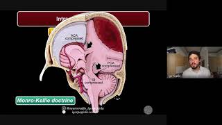 PRESSÃO INTRACRANIANA [upl. by Aiki]