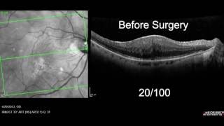 Macular Pucker with OCT Retinal Scan beforeafter surgery [upl. by Tterrag]