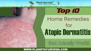 Top 10 Home Remedies For Atopic Dermatitis Eczema That Actually Work [upl. by Jethro545]