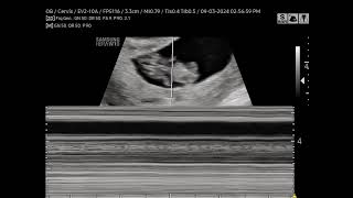 1ST TRIMESTER DATING HEARTBEAT [upl. by Naitsabas28]