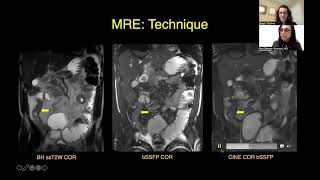 CT Versus MR Enterography PointCounterpoint [upl. by Eednas]