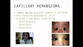 Periocular capillary hemangioma management  Video abstract 39029 [upl. by Kehsihba]