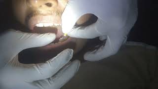 lower left side Deciduous tooth first molar RCT process step 1 [upl. by Clymer194]