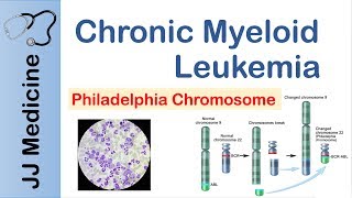 Chronic Myeloid Leukemia CML  Pathogenesis Symptoms and Treatment [upl. by Shannah]