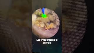 LASER para piedras del riñón  urotips [upl. by Drarrej]