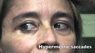 Case Challenge The patient had hypermetric saccades Video 1 [upl. by Meelas]